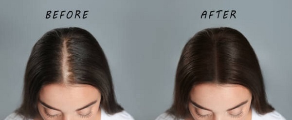 hair loss female before and after