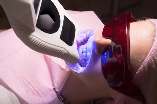 Laser teeth weighting process