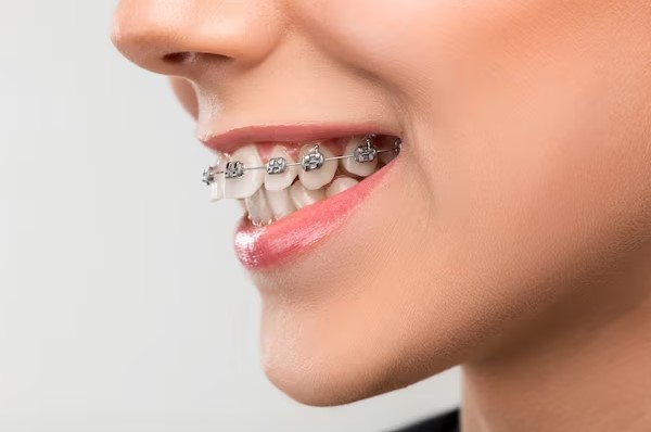 Steel braces in fix in teeth