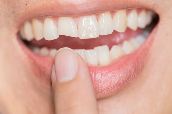 Should You Ignore a Slightly Chipped Tooth?