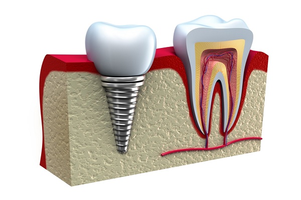 How Long Do Dental Implants Last? A Helpful Guide