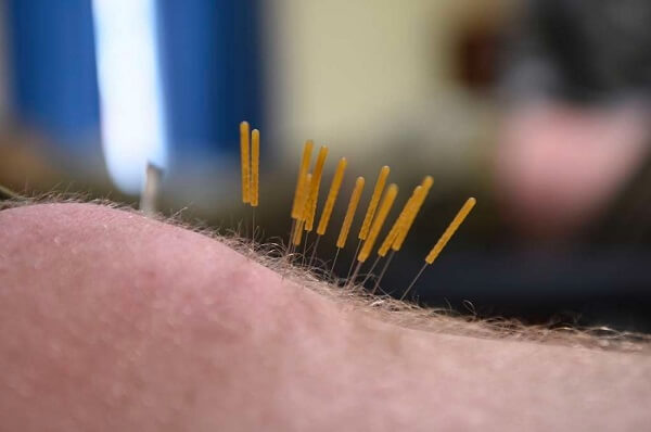 needles in persons body